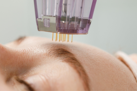 Skin rejuvenation at Back to 30 Greenville SC